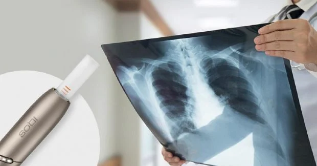 Рентген легких и айкос